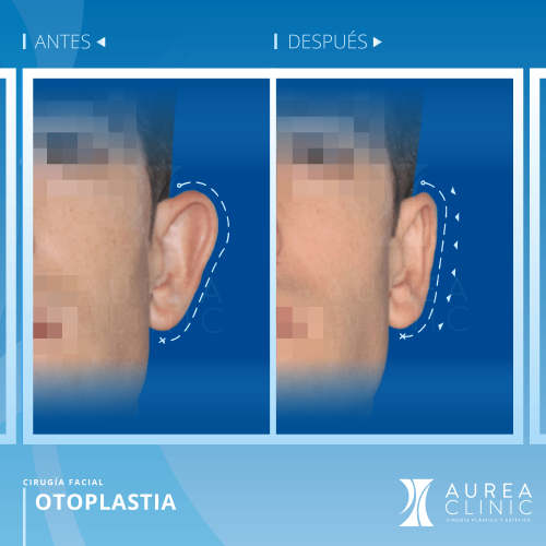 Otoplastia